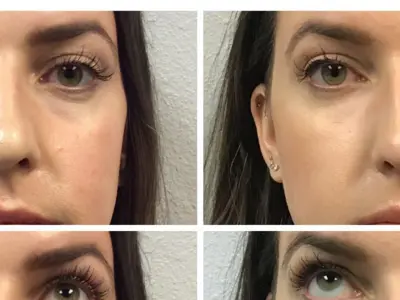 restylane